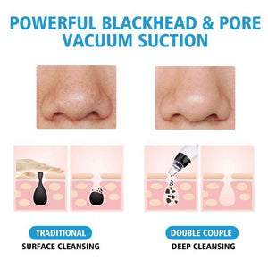 Blackhead Remover Vacuum - Pimple & Acne Suction Tool
